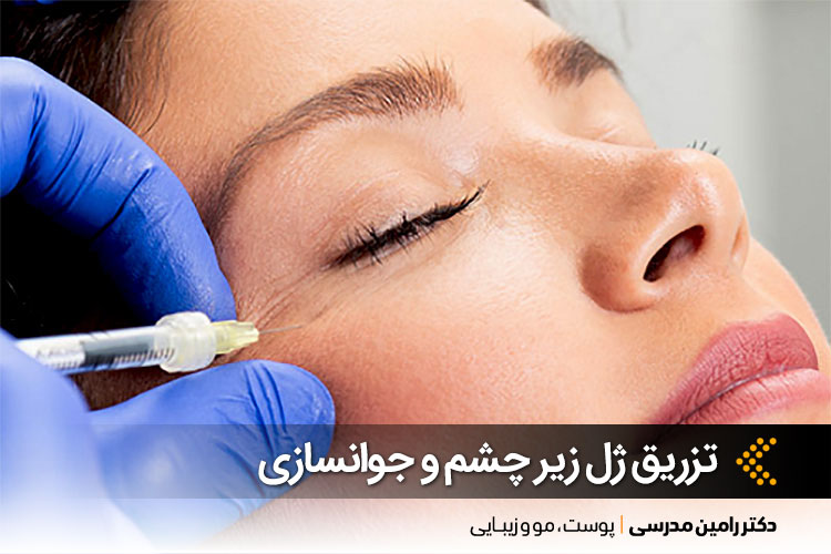 تزریق ژل زیر چشم در اصفهان