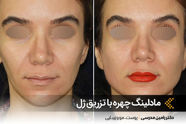 مادلینگ چهره با تزریق ژل در اصفهان
