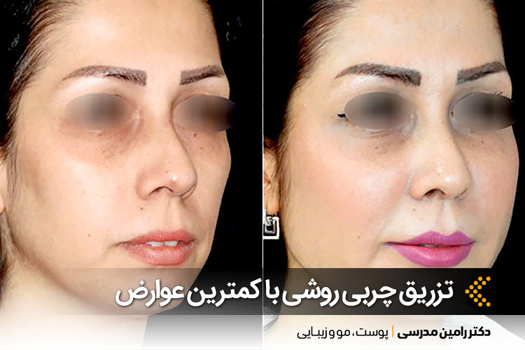 تزریق چربی با کمترین عوارض در اصفهان