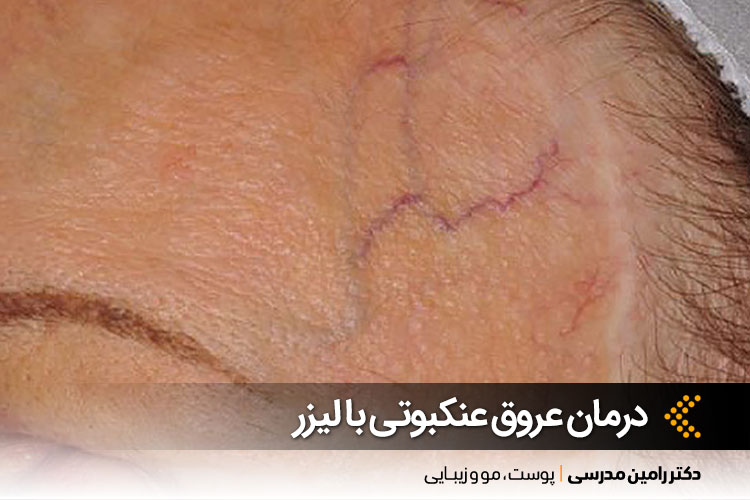 درمان عروق عنکبوتی در اصفهان