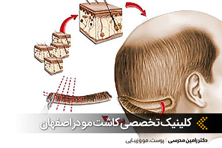 بهترین کلینیک کاشت مو در اصفهان