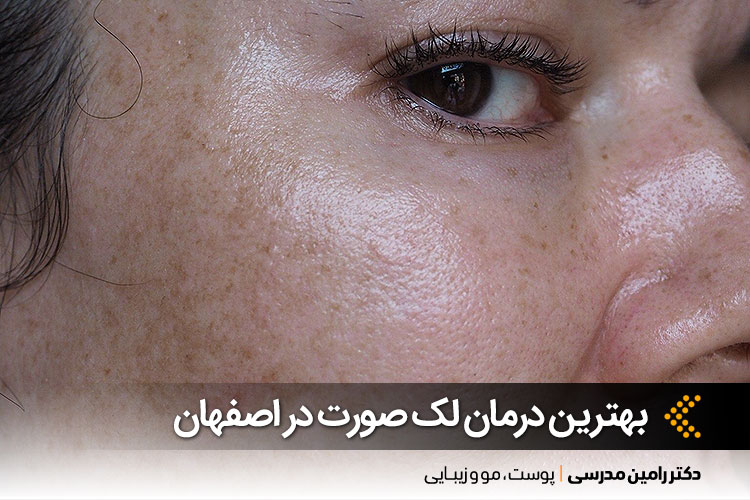 درمان لک صورت در اصفهان