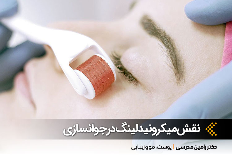 میکرونیدلینگ در اصفهان