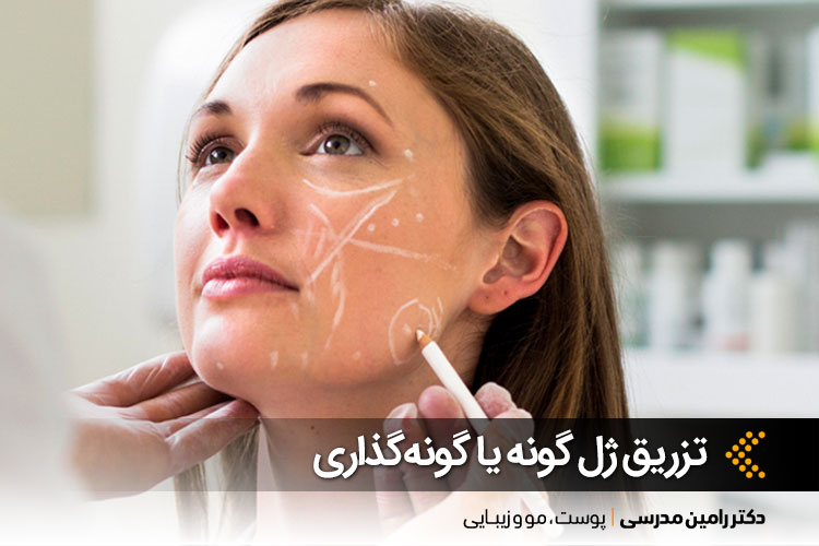 بهترین تزریق ژل گونه در اصفهان