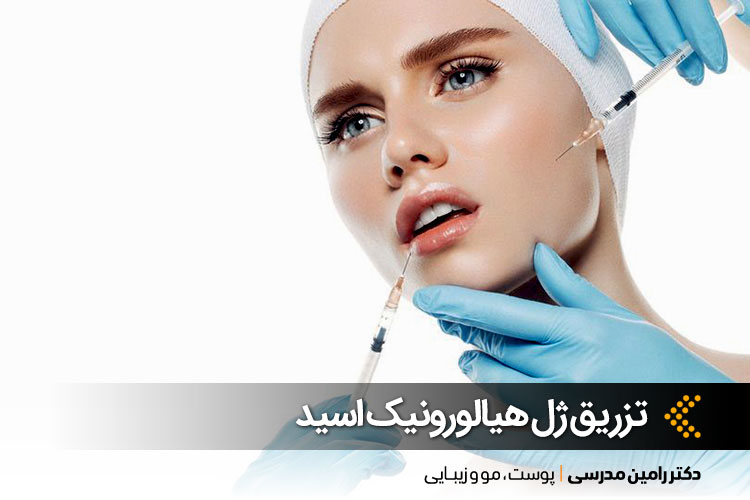 تزریق ژل هیالورونیک اسید در اصفهان