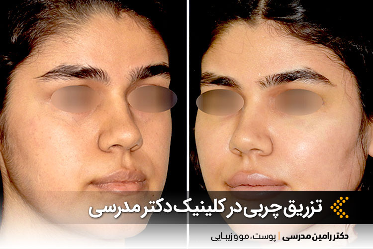 نمونه کار تزریق چربی صورت در کلینیک دکتر رامین مدرسی