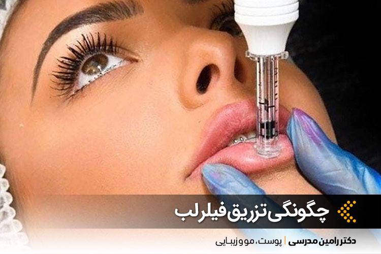 تزریق فیلر لب چگونه است؟