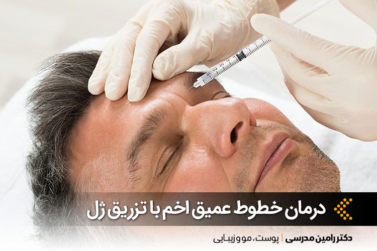 تزریق ژل خط اخم در اصفهان