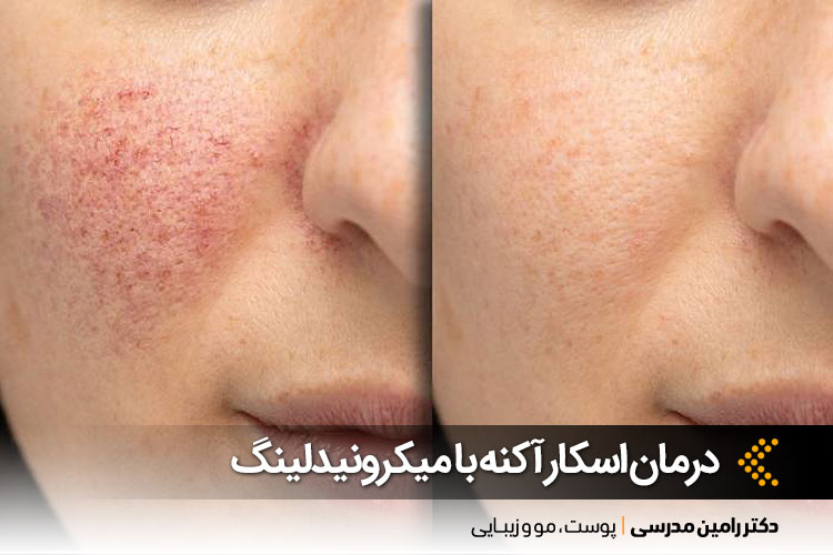 درمان اسکار آکنه در اصفهان